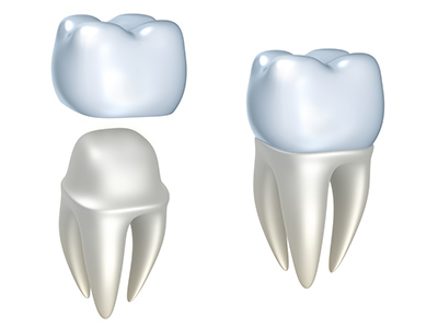 The Different Types of Crowns