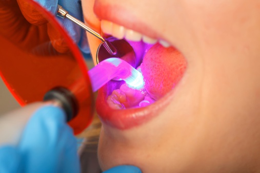 What to Expect if You Have Your Teeth Bonded?