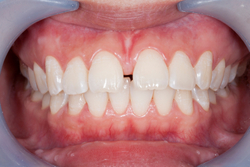 Close-up of teeth with a gap at East Village Dental Centre