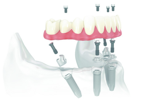 Need To Know Facts About the All-on-4® Procedure?