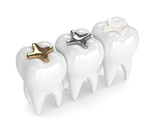 3D rendering of three teeth, each with a different dental filling material: composite, amalgam, and gold.