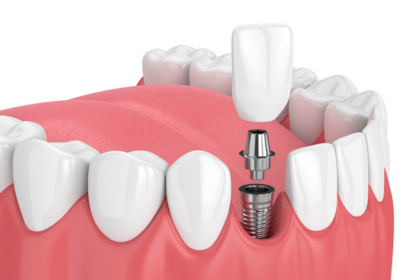 tooth implant types