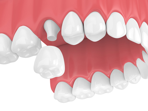 Rendering of jaw with dental crown from East Village Dental Centre in Chicago, IL