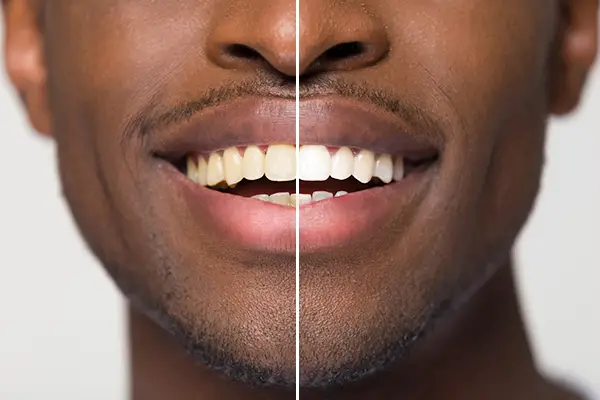 Close-up comparison of before and after teeth whitening treatment on a man's smile.