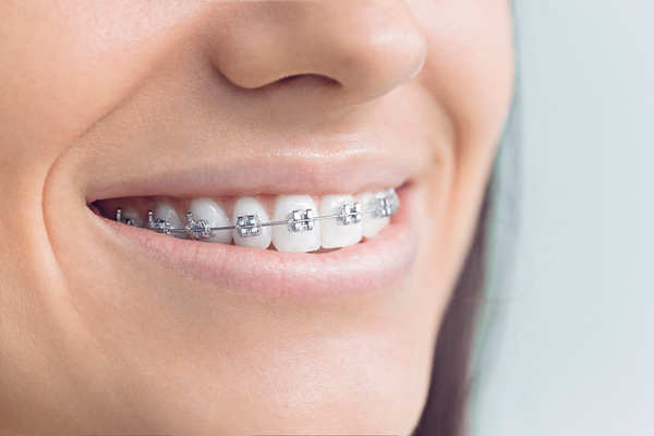 Close up of smiling woman with metal braces at East Village Dental Centre in Chicago.