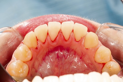 Five Signs of Gum Diseases